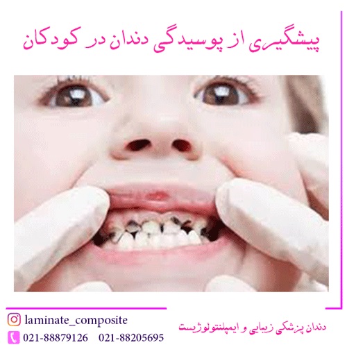دندانپزشکی اطفال بدون بیهوشی - دکتر فرزانه فرخ نژاد دکترای دندانپزشکی