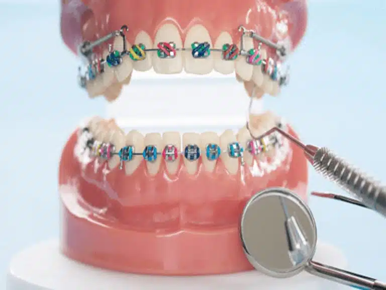 همه چیز در مورد ارتودنسی دندان - دکتر فرزانه فرخ نژاد دکترای دندانپزشکی