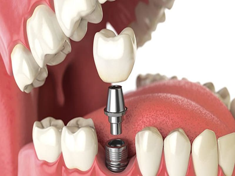 نکات کاربردی در رابطه با ایمپلنت دندان