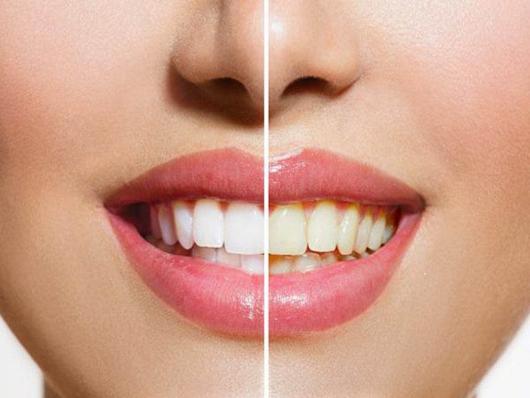 سفید کردن یا بلیچینگ دندان‌ در تهران - دکتر فرزانه فرخ نژاد دکترای دندانپزشکی