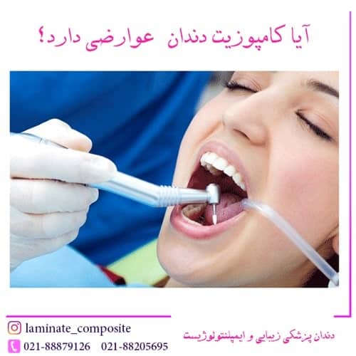  متخصص کامپوزیت دندان در تهران