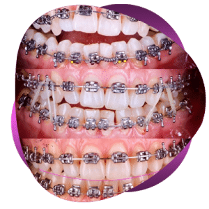 در مورد ارتودنسی دندان بیشتر بدانید