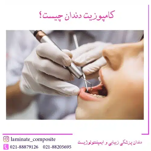 بهترین متخصص کامپوزیت دندان در تهران