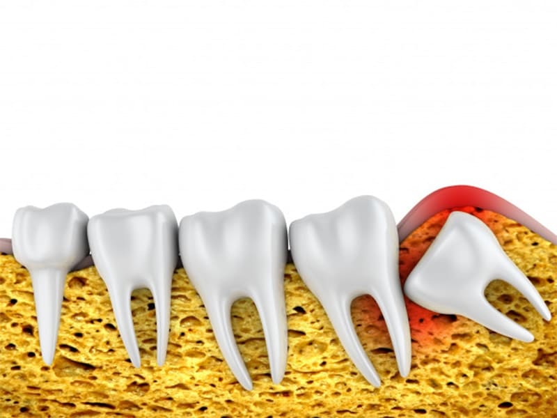 از جراحی دندان نهفته چه می دانید؟