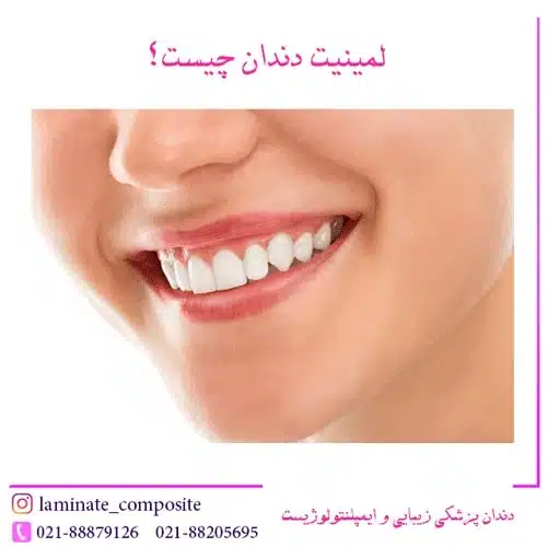 از لمینیت سرامیکی دندان چه می دانید؟ 1 از لمینیت سرامیکی دندان چه می دانید؟ | فرزانه فرخ نژاد دندانپزشک زیبایی