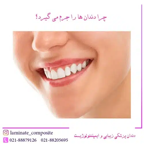 جرم گیری دندان در تهران 1 جرم گیری دندان در تهران