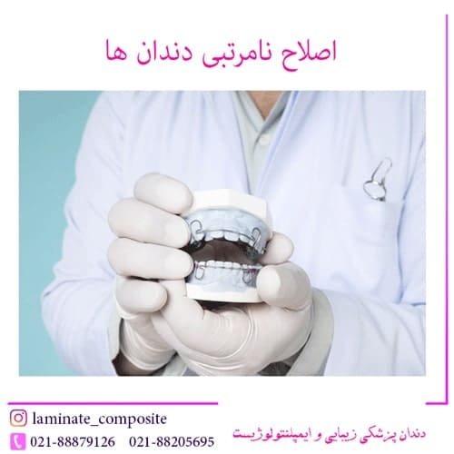 اصلاح نامرتبی دندان ها بدون ارتودنسی – تصویر ۲