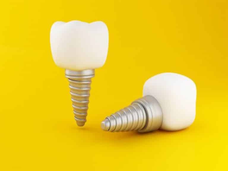 تکنیکی موثر به نام ایمپلنت اوردنچر - دکتر فرزانه فرخ نژاد دکترای دندانپزشکی