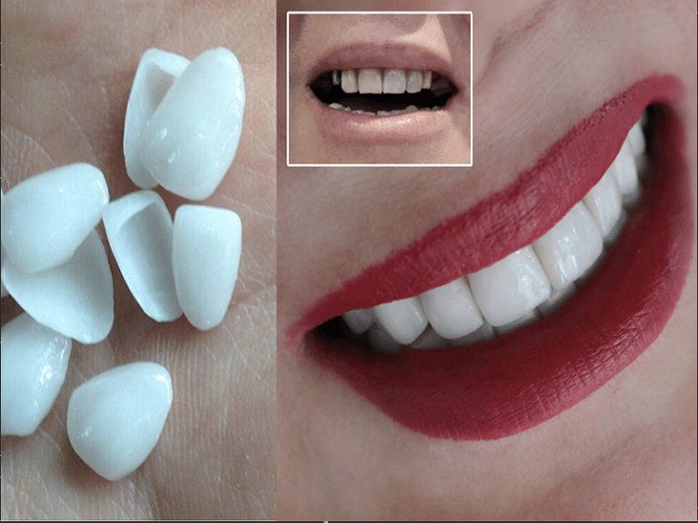 لمینیت زیبایی دندان ها