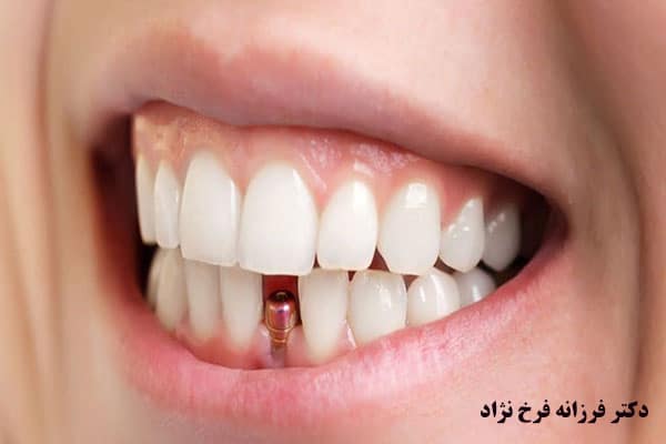 ایمپلنت دندان جلویی و قیمت کراودینگ دندان