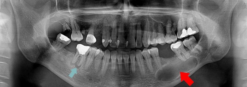 عکس از ریشه دندان
