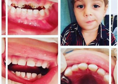 نمونه ای از دندانپزشکی اطفال
