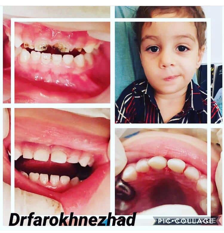 نمونه ای از دندانپزشکی اطفال