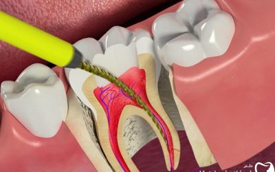 درمان ریشه دندان درتهران