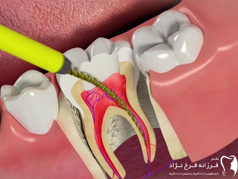 درمان ریشه دندان درتهران