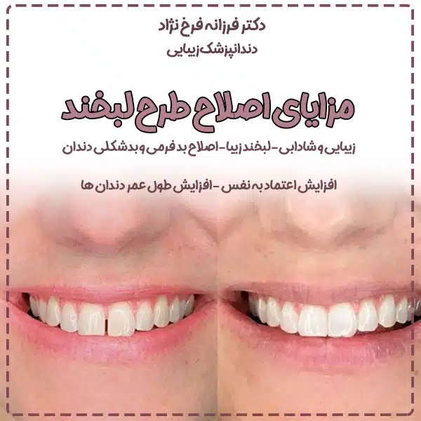اصلاح طرح لبخند و بهترین دکتر برای طرح لبخند در تهران 10 مزایای-اصلا-طرح-لبخند-در- تهران