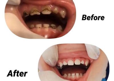 قبل و بعد از ترمیم دندان کودکان