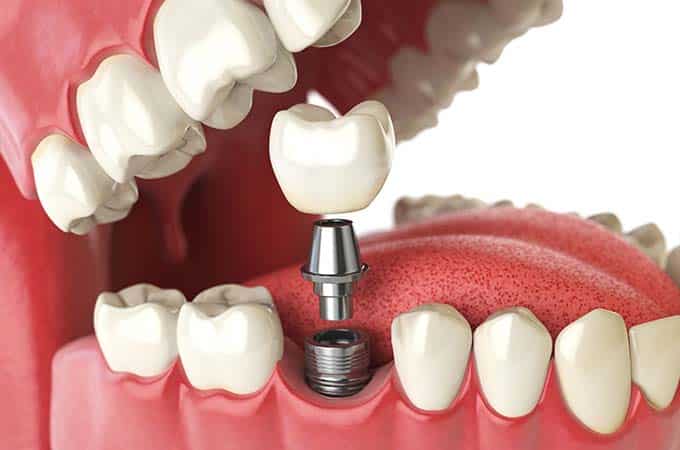 نکات کاربردی در رابطه با ایمپلنت دندان