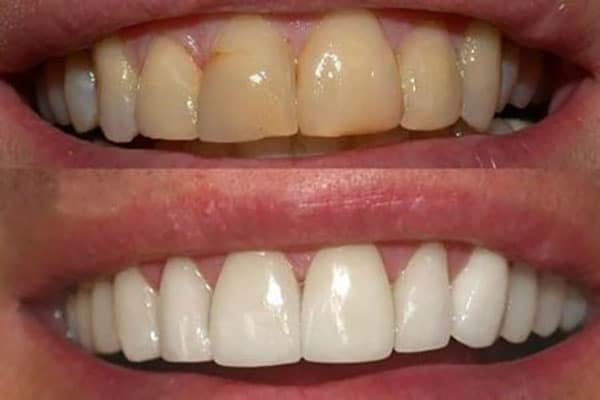 بلیچینگ-دندان-در-تهران