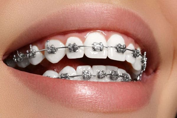قیمت ارتودنسی دندان در تهران در سال 1402 - دکتر فرزانه فرخ نژاد دکترای دندانپزشکی