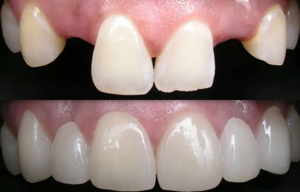 نمونه کار بریج دندان