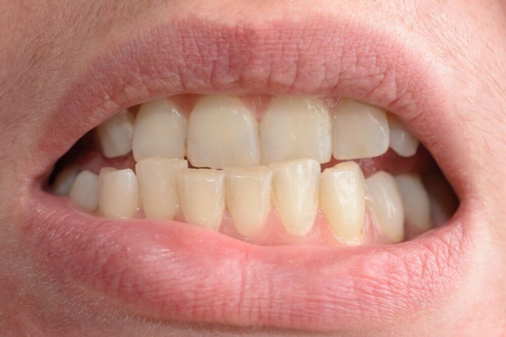 نمونه کار کراودینگ دندان