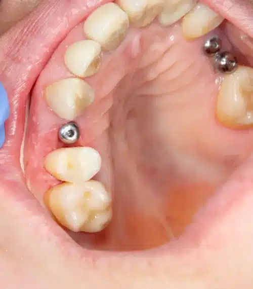 ایمپلنت دندانی