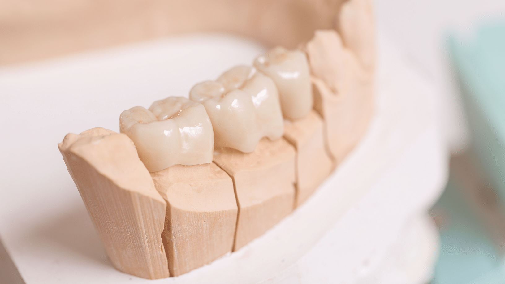 بریج دندان یا پل دندانی چیست؟ 