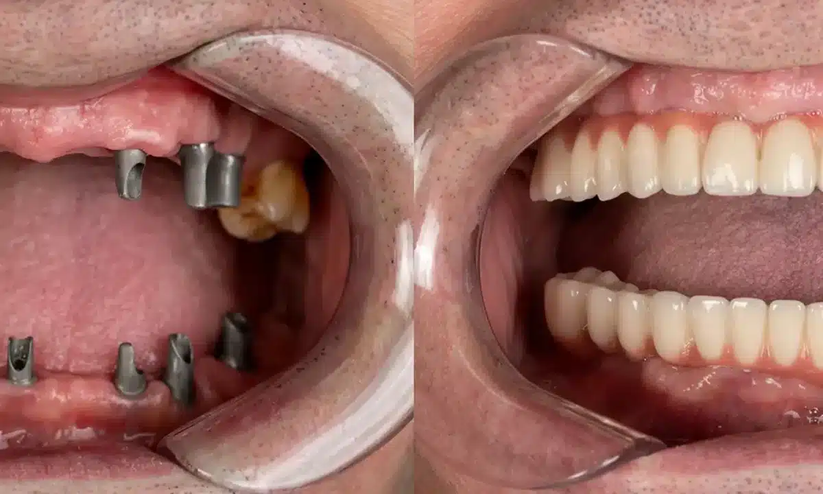 نتایج ایمپلنت دندان