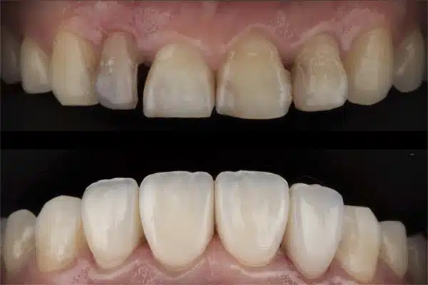 فیلم کامپوزیت دندان