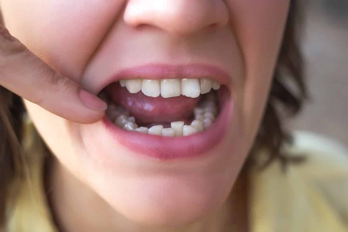 روش‌های موثر برای پیشگیری از کراودینگ دندان