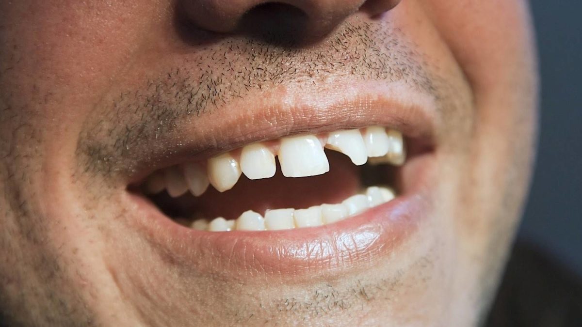هزینه ترمیم دندان شکسته در تهران
