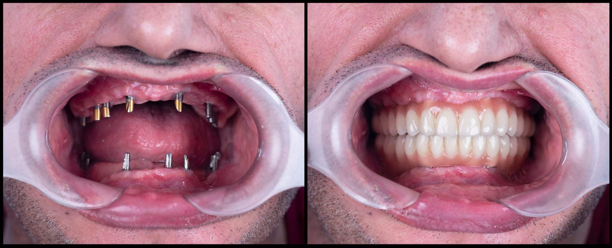 کاربردهای ایمپلنت دندان
