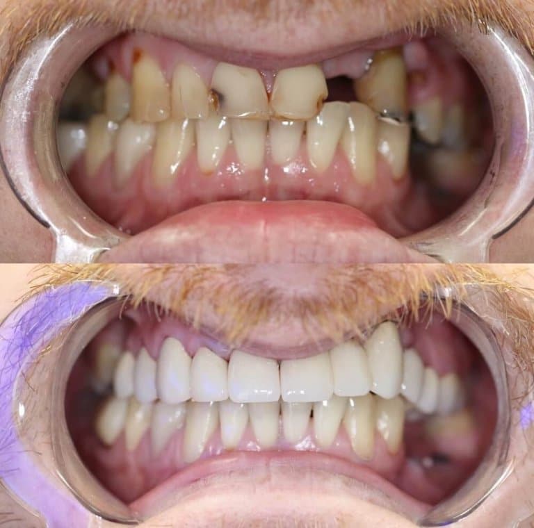 قبل و بعد ایمپلنت دندان