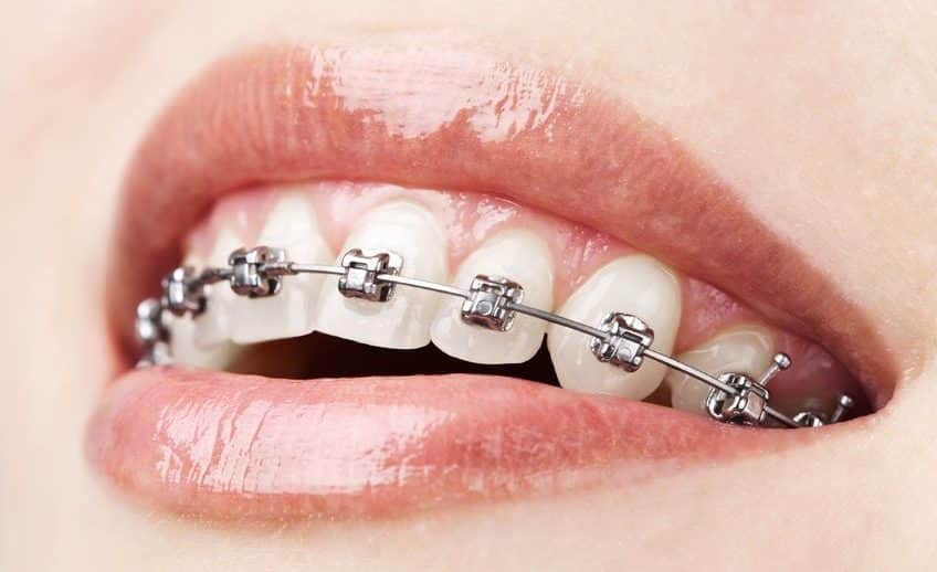 نمونه کارهای ارتودنسی دندان