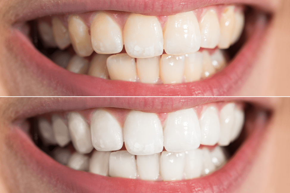 نمونه کار بلیچینگ دندان