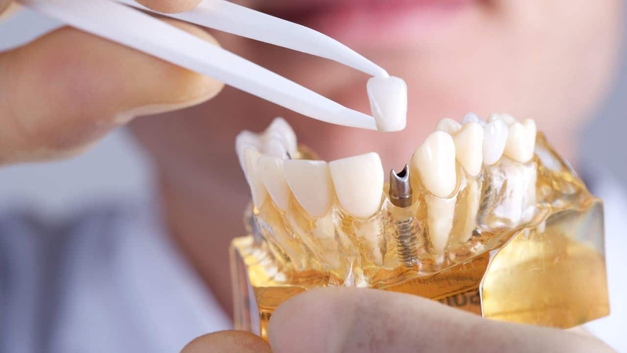 مزایا ایمپلنت دندان