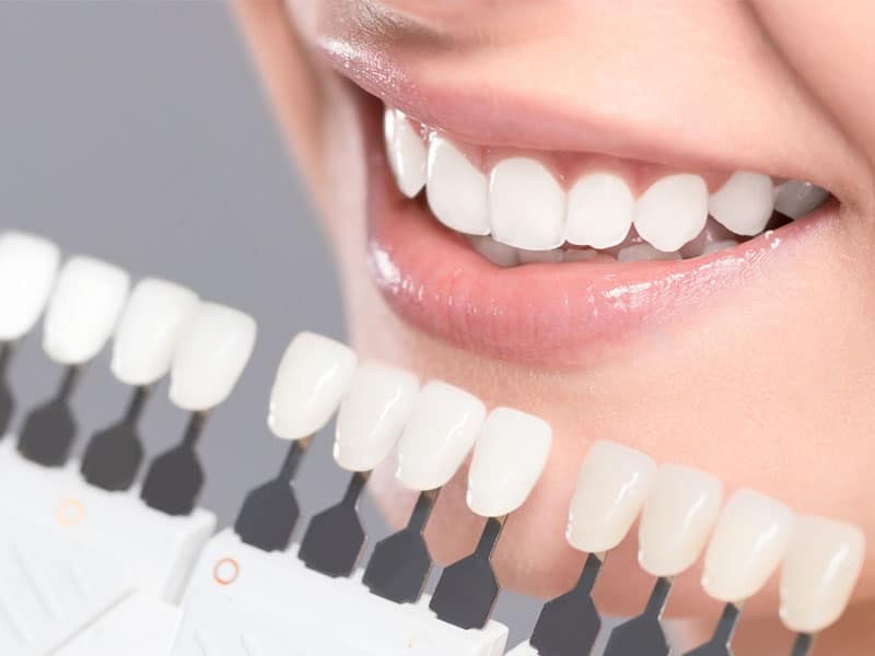 بهترین رنگ لمینت دندان