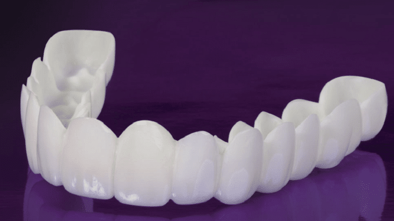 لمینت متحرک دندان