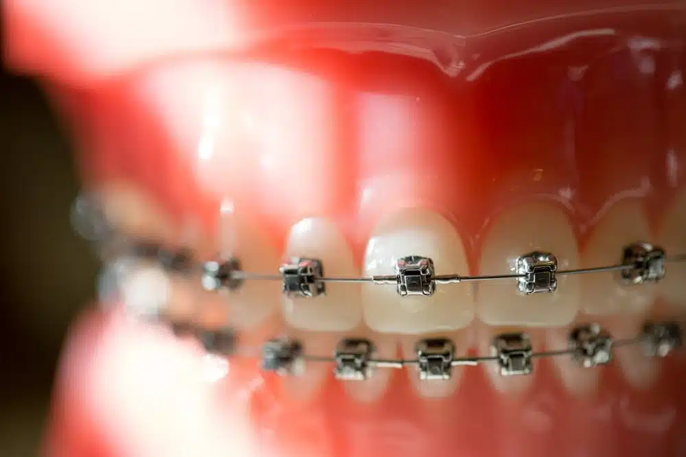 ارتودنسی دیمون