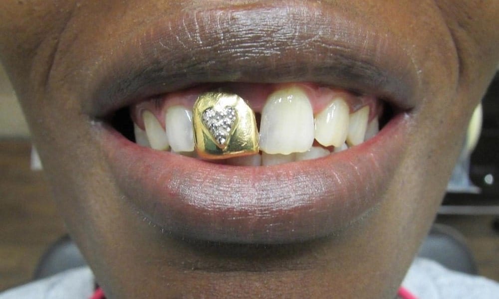 انواع لمینت دندان طلا
