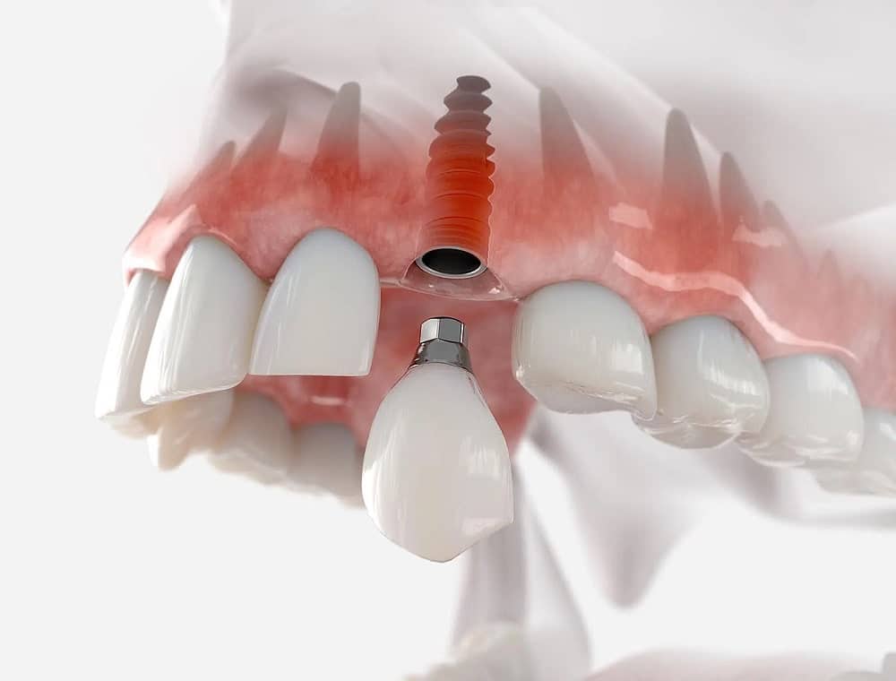 اهمیت ثبات و دوام ایمپلنت‌های دندانی