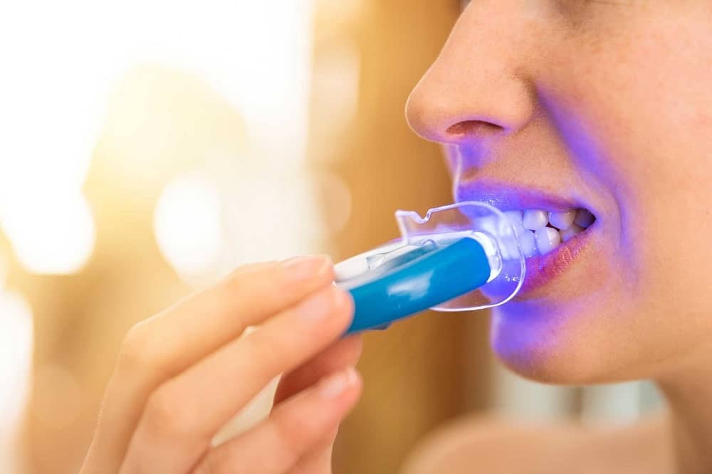 روش‌های سفید کردن کامپوزیت دندان