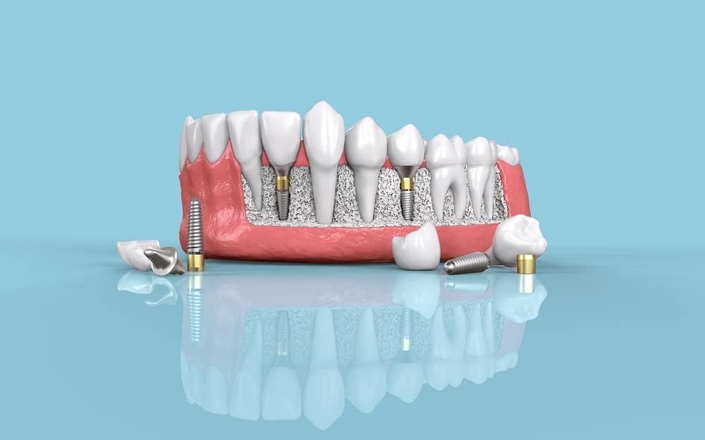شرایط لازم برای انجام ایمپلنت فوری دندان