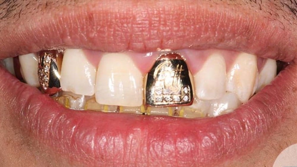 لمینت دندان طلا چیست؟