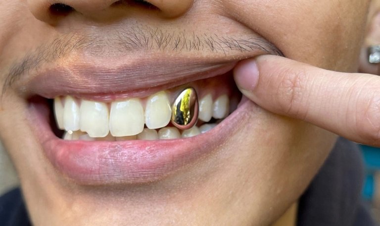 لمینت دندان طلا