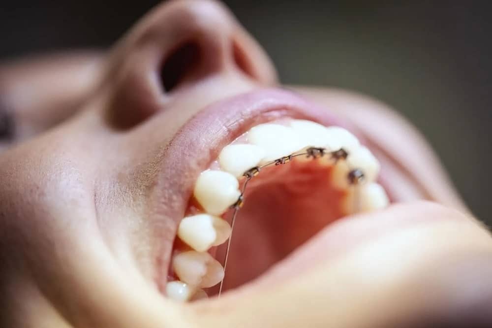 مزایای ارتودنسی پشت دندانی