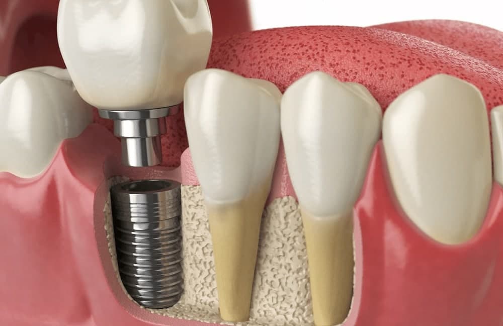 مزایای ایمپلنت سریع دندان چیست؟