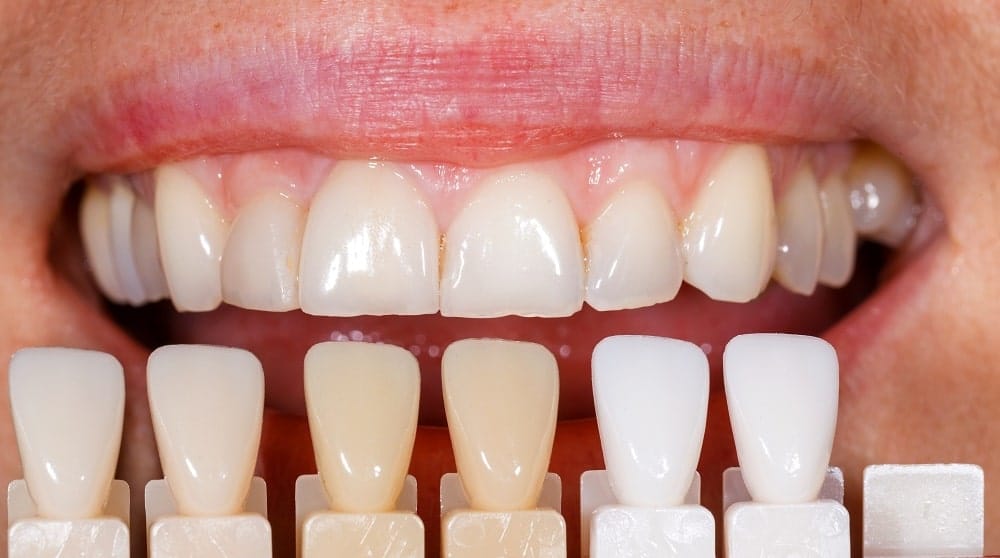 مزایای بلیچینگ دندان در خانه