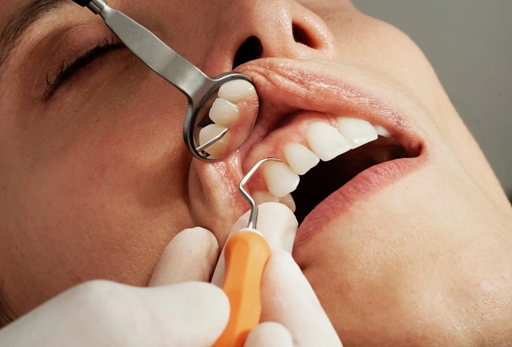 نوع کشیدن دندان